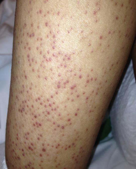 Vitamin C (Ascorbic Acid) Nutrition Medbullets Step 2/3